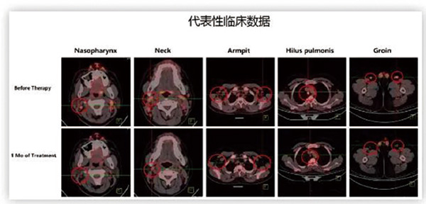 256-257期《全球肿瘤快讯》-89.jpg