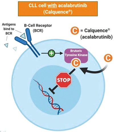 一线治疗慢性淋巴细胞白血病 Acalabrutinib、维奈克拉联合奥比妥珠单抗有研究价值
